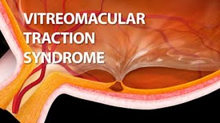 Vitreomacular Traction Syndrome [upl. by Aicitan]