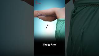 Transform Your Arms with Brachioplasty Arm Lift Before and After shortvideo [upl. by Kcirddes]