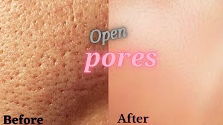 How To Minimise Pores  How To Shrink Open Pores Permanently 100 Results [upl. by Northington35]