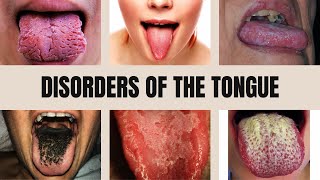 Tongue Diseases Geographic Tongue Black Hairy Tongue Glossitis Thrush and Leukoplakia [upl. by Sudoeht928]