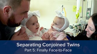 Separating Conjoined Twins Part 5 Finally FacetoFace [upl. by Anihta]