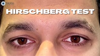 Hirschberg Test [upl. by Rodney593]