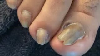 ACRYLIC TOENAILS ON SEVERELY DAMAGED NAILS [upl. by Iramohs]