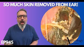 SO MUCH SKIN REMOVED FROM PATIENTS EAR CANAL  EP945 [upl. by Norga]