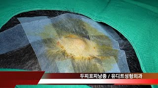 Dermoid cyst on SCALP 두피피지낭종 removal surgery [upl. by Eessej]