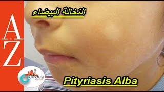 Pityriasis alba  From A to Z  النخالة البيضاء  اسبابها  أعراضها  طرق العلاج والوقاية [upl. by Anitsugua]