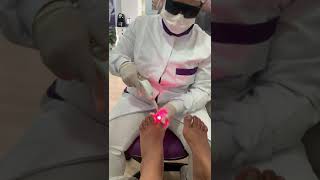 Laser Para tratamento de micose de unha [upl. by Inele]