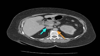 Clinical Case Renal Cell Carcinoma [upl. by Cooke]