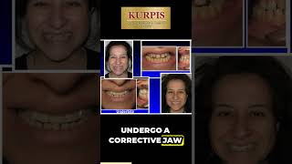 Underbite Correction Without Jaw Surgery [upl. by Alimak44]