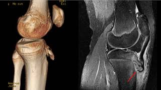 Knee patellar tendon avulsion fracture tibial tuberosity fracture [upl. by Ecinuahs327]