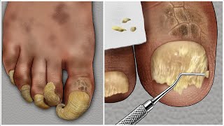 ASMR 두꺼운 무좀 발톱 케어 애니메이션  thick athletes foot toenail treatment animation [upl. by Eedoj914]