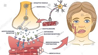 Myasthenia Gravis  the effects [upl. by Ellga]