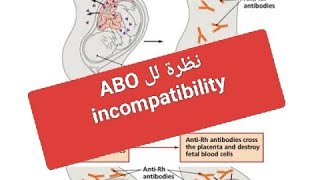 CME and ABO Incompatibility [upl. by Brodench797]