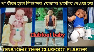 Clubfoot baby Tenatomy জন্মগত পা বাঁকা শিশুOur Treatment [upl. by Ahsir305]