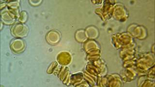 SPIROCHETES  coming out of a WBC [upl. by Dlanger]