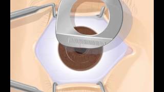 How LASIK Surgery is Done [upl. by Brebner643]