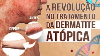 A revolução no tratamento da dermatite atópica [upl. by Suzie]