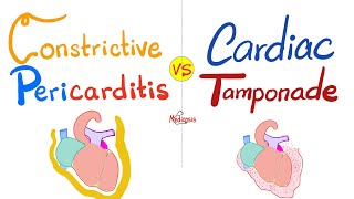 Constrictive Pericarditis vs Cardiac Tamponade  Cardiology Series [upl. by Young]