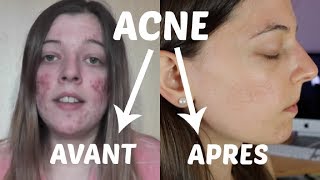 ACNE  Mon expérience et traitements naturels [upl. by Branch]