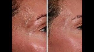 mini face lift before and afterfacelift massage at homeliquid faceliftfacial rejuvenation [upl. by Chafee]