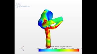 CFD Simulation of a PatientSpecific Intracranial Aneurysm [upl. by Checani341]