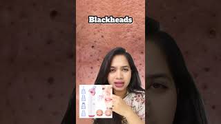 🤔 How to Remove Blackheads [upl. by Culver]