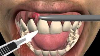 How to treat a tooth abscess [upl. by Aubrey148]