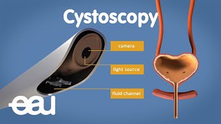 Cystoscopy overactive bladder [upl. by Ostler]