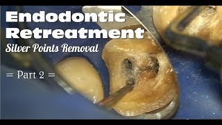 Endodontic Retreatment  Silver Points Removal Part 2 [upl. by Adnirb]