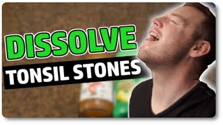 Dissolve Tonsil Stones At Home With Only 3 Ingredients [upl. by Nauqas]