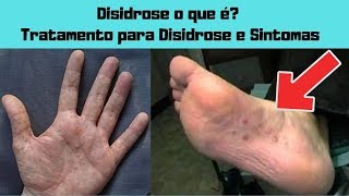 DISIDROSE → Disidrose o que é Tratamento para Disidrose e Sintomas [upl. by Euqinimod]