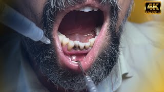 “Is Pulling a Tooth That Easy Dentist Explains in 1 Minute” Subtitled [upl. by Haiacim]