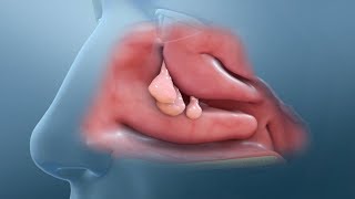 Nasal Polyp Removal Surgery [upl. by Sissie]