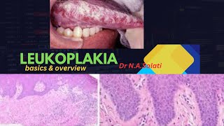 Leukoplakia Differential Diagnosis [upl. by Mutz938]