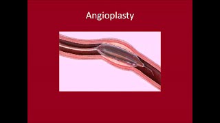 Angioplasty [upl. by Seraphim433]