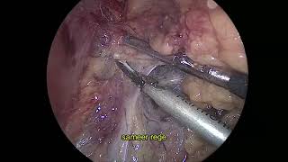 Lap right retroperitoneal adrenalectomy for Conns syndrome [upl. by Nam]