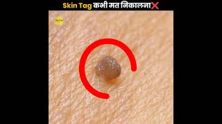 Skin Tag कभी मत निकालना ❌  Never Remove Skin Tag  The Fact  shorts ytshorts [upl. by Nitsuga]