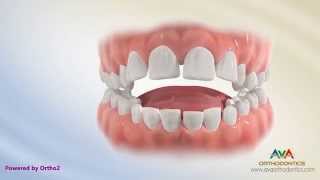 Orthodontic Treatment for Tongue Thrusting Habit  Different Options [upl. by Isadora242]