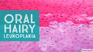 Oral Hairy LeukoplakiaExplained by a Dermatopathologist [upl. by Yhtnomit]