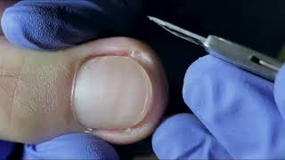 Ingrown Toenail Removal  Pedicure Treatment and Very Satisfying  Best Satisfying Nail Cutting [upl. by Eendyc]