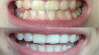 How I whitened my VERY yellow teeth WORKS BEFORE AND AFTER [upl. by Fabio]