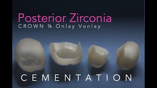 Zirconia Ceramics Part 5 Posterior Onlay 34 Vonlay and Crown Cementation [upl. by Margaret390]