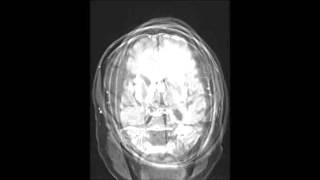 Primary CNS Lymphoma [upl. by Ader]