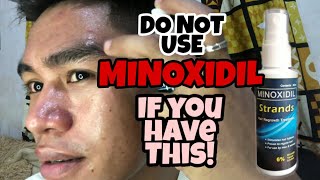 YOU MUST KNOW THIS IF YOU TRY TO USE MINOXIDIL FOR EYEBROW [upl. by Isej]