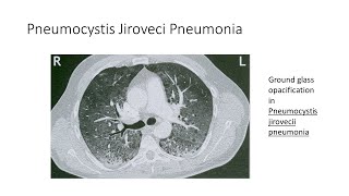 Pneumocystis Jirovecii Pneumonia [upl. by Oletha]