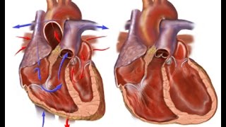 Congestive Heart Failure [upl. by Rebah]