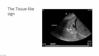 Lung Ultrasound Alveolar Consolidation  Shred Sign [upl. by Rafe767]