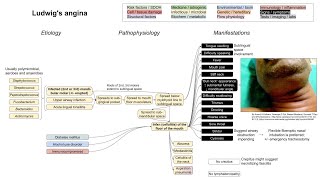 Ludwigs angina mechanism of disease [upl. by Zat]