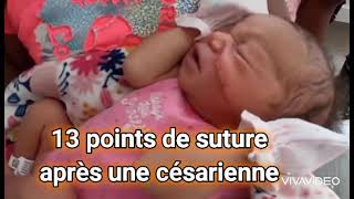 13 points de suture au visage après une césarienne 😲😲 [upl. by Thesda]