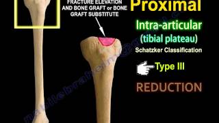 Tibial Plateau Fracture Fixation Proximal Tibia  Everything You Need To Know  Dr Nabil Ebraheim [upl. by Eldreda]